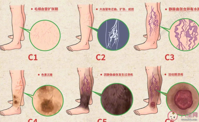 腿上出现红血丝或是疾病信号 腿上出现小蚯蚓怎么办