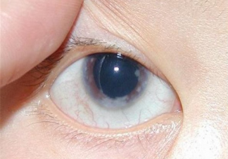 什么是青光眼 青光眼怎么预防