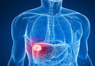 体检发现肝结节怎么办 哪些人要特别注意保护肝脏